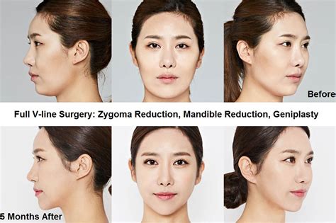 lv plastic surgery seoul|best korean cosmetic surgery clinic.